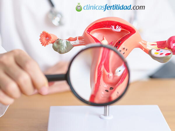 ¿Cuáles son los síntomas de la endometriosis y cómo afecta a la fertilidad?