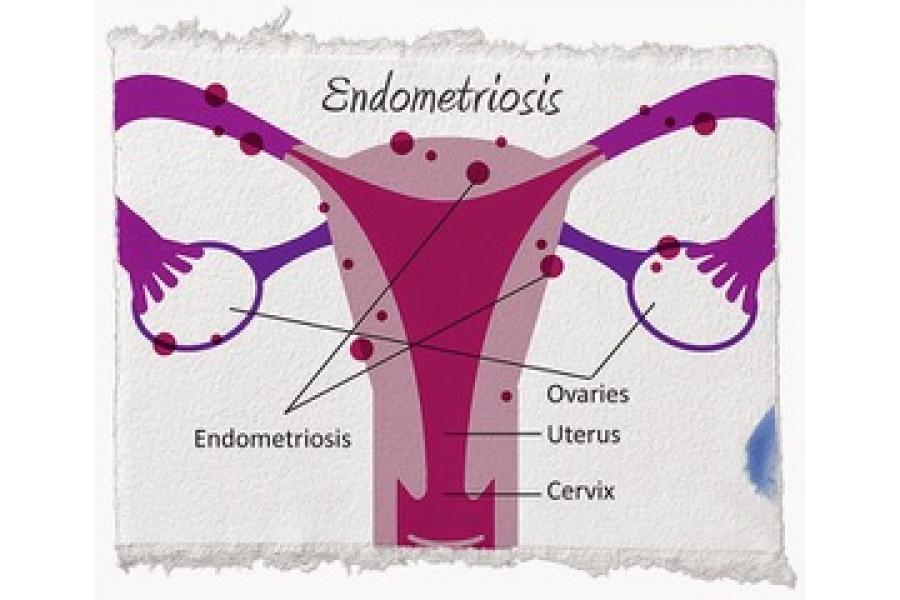 Endometriosis: síntomas, diagnóstico y tratamiento