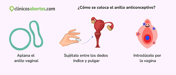 Como se coloca el anillo vaginal
