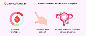 Cómo funciona el implante anticonceptivo