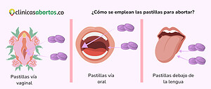 ¿Cómo se emplean las pastillas para abortar?