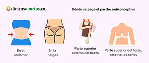 Dónde se pega el parche anticonceptivo
