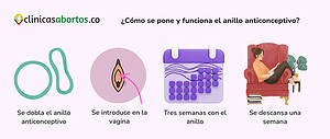 ¿Cómo se pone y funciona el anillo anticonceptivo?