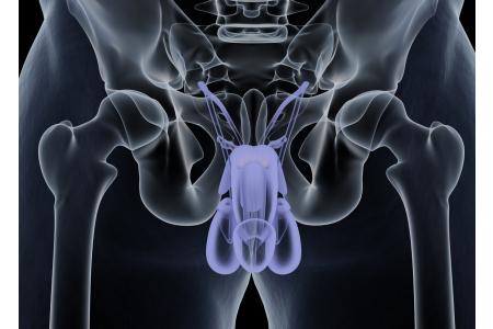 cancer de pene