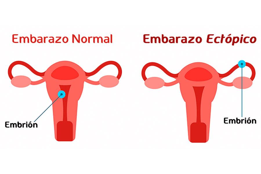 embarazos ectopicos