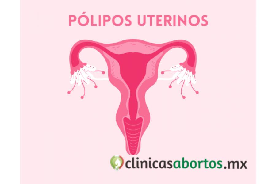 polipos endometriales